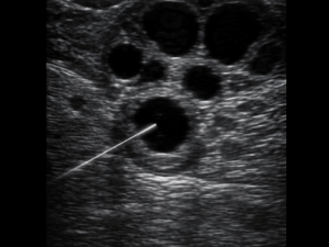 aspiracao-folicular
